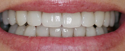 Harley St dental implants London implant with crown